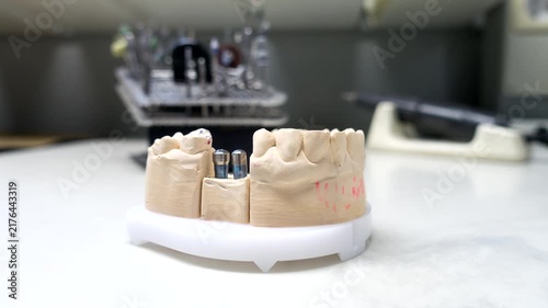 model of the human jaw with dental implants