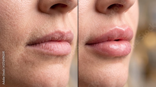 Before and after lip hydration showing dry chapped texture changing into smooth shine