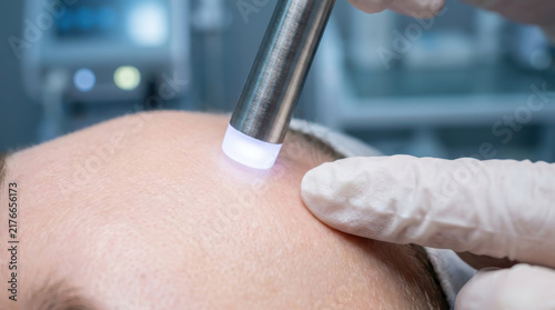 Close Up of Laser Skin Treatment on Forehead