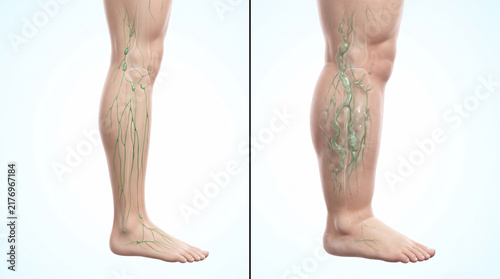 Normal Lymphatic Drainage vs Lymphedema Swollen Limb Comparison