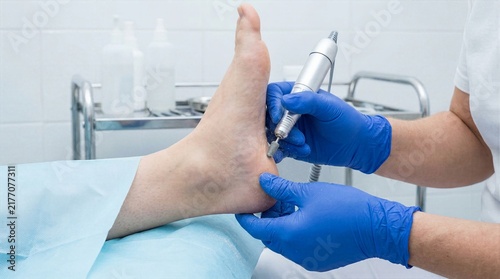 Close up of hardware medical pedicure treatment where podiatry expert uses rotating abrasive burr to smooth rough skin and cracks on human heel