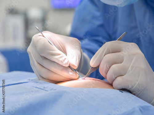 Surgeon Hands In Sterile White Gloves Performing Delicate Minor Surgical Procedure On Patient Skin, Professional Medical Healthcare Concept