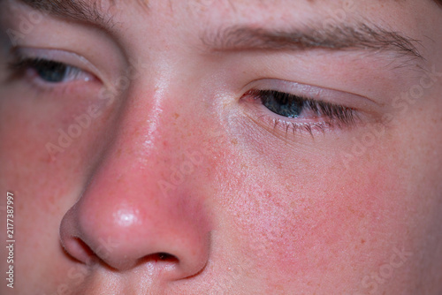 Konstfotografi child's face with reddened sunburned cheeks and nose looking down close up skin