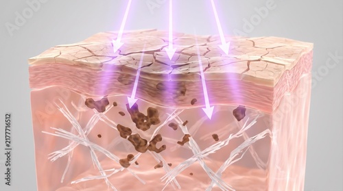 A 3D medical cross-section showing skin damage with UV light rays penetrating damaged layers.
