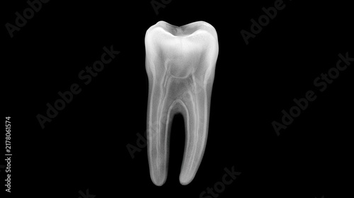 X-ray image of a single tooth structure showcasing detailed features and intricate anatomy of dental health
