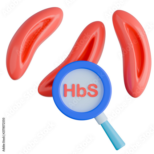 3D illustration of sickle red blood cells and HbS magnifying glass, representing sickle cell anemia and abnormal hemoglobin S pathology.
