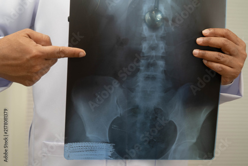 Foto Doctor examining spine bone radiography xray film.