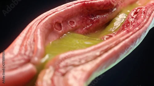 Cross Section of Inflamed Esophagus with Peptic Ulcers and Green Bile Acid