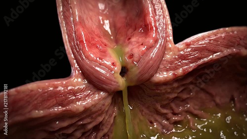 3D Animation of Stomach Acid Refluxing Through Lower Esophageal Sphincter