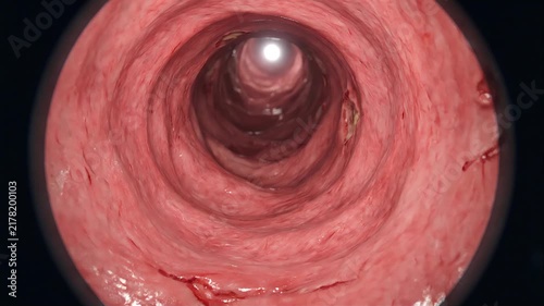Virtual Endoscopy Flythrough of Gastrointestinal Tract Showing Bleeding Ulcers