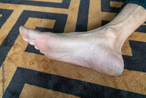 Konstfotografi A person's feet and lower legs resting on a patterned surface, showing prominent, clearly visible superficial blood vessels on the dorsum of the foot and around the ankle