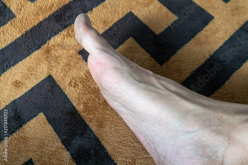 Canvastavla Close up side view of a human foot resting on a patterned carpet, highlighting the skin texture as well as the position of the forefoot and the big toe joint