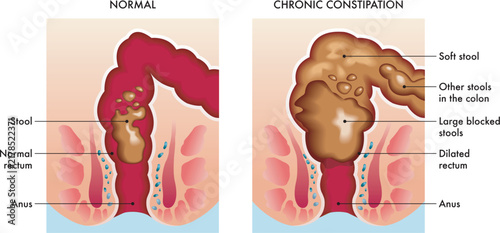 Medical illustration showing the difference between a normally functioning colon and one afflicted by chronic constipation, with annotations.