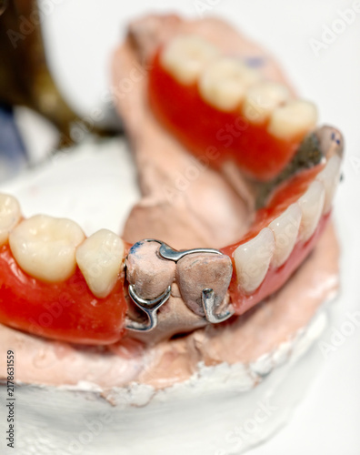 Close-up of removable partial denture on plaster mold