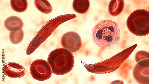 Canvas Print Sickle cell anaemia, 3D illustration of sickle-shaped red blood cells among norm