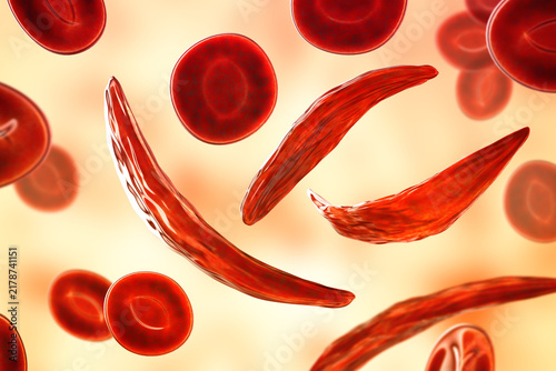Sickle cell anaemia, 3D illustration of sickle-shaped red blood cells among normal erythrocytes circulating in blood