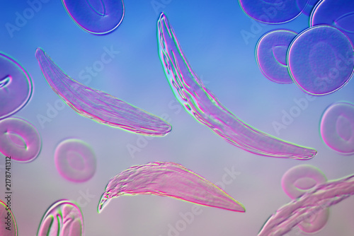 Sickle cell anaemia, 3D illustration of sickle-shaped red blood cells among normal erythrocytes circulating in blood