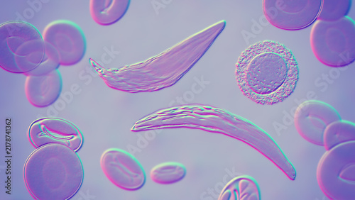 Fotografie Sickle cell anaemia, 3D illustration of sickle-shaped red blood cells among norm