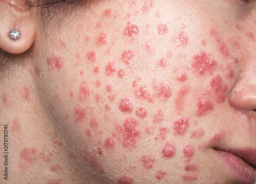 Closeup of a persons cheek with numerous red inflamed acne lesions and pustules covering the skin