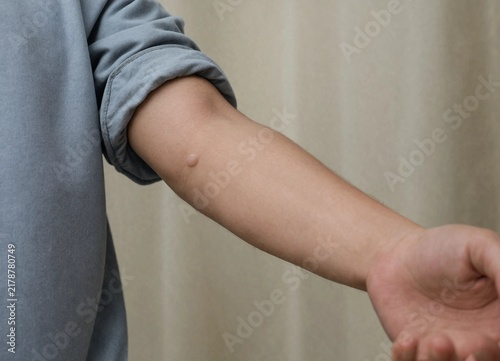 Closeup shot of a persons forearm showing a small blister on the skin surface