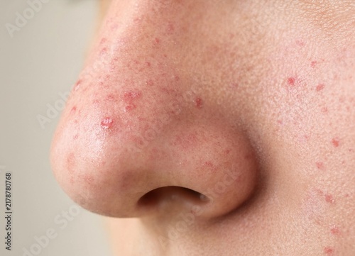 Extreme closeup detailed shot of human nose skin with redness and acne breakouts