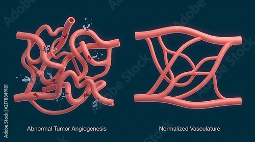 Detailed medical illustration comparing abnormal tumor angiogenesis versus