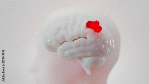 Brain damage abnormalities or foreign. Cancer tumor malignant cells growth and spreading. Can be used in medical elements related meningioma or neurological disease. Minimal idea concept, 3D Render.