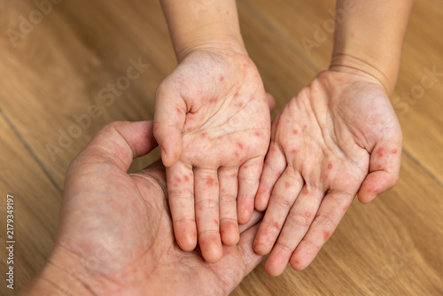 Sick child with hand foot and mouth disease showing red rash and skin lesions on the hands and feet, with a caregiver examining the symptoms and providing home care.