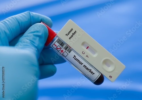 Blood sample of patient negative result for tumor marker.