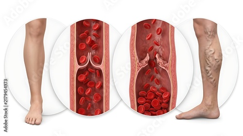 Healthy vein vs varicose vein with damaged valves and blood pooling in human leg