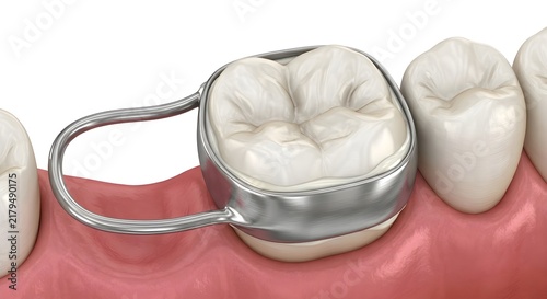 Highly Detailed 3D Render of an Orthodontic Space Maintainer Cemented on a Molar Tooth
