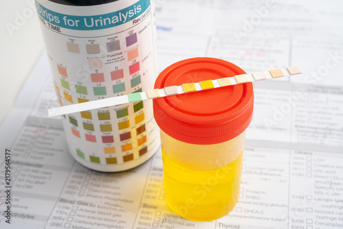 Obraz na płótnie Urinalysis, urine cup with reagent strip pH paper test and comparison chart in laboratory