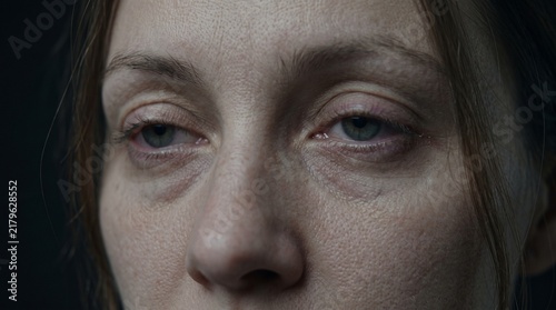 Horizontal macro close-up photo of a tired woman's face with sleepy eyes and dark circles due to bad sleep