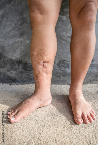 Fotografie Skin lesions resulting from accidents.