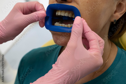 Fotografie Close-up of a female patient wearing a blue cheek and lip retractor during a dental examination in a clinic