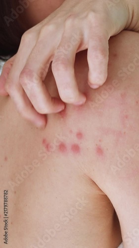 A woman scratches her shoulder bitten by a bedbug on a white background, close-up. Skin health problem. Red pimples.	