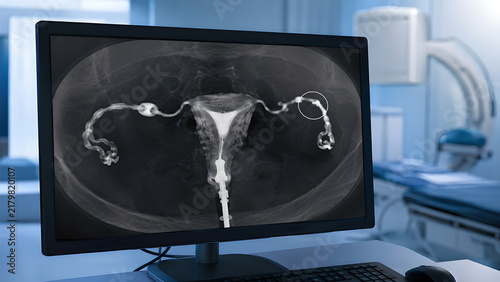 Fallopian tube blockage radiology image showing early-stage tubal obstruction on pelvic diagnostic imaging monitor in a clinical hospital setting for healthcare, radiology, and patient education