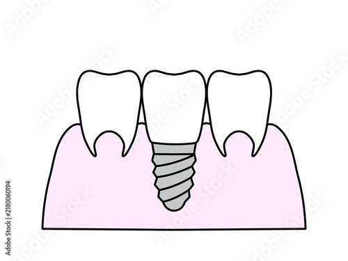 human tooth with a tooth