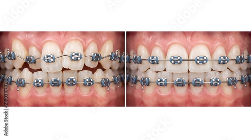 Orthodontic Before and After Comparison Showing Teeth Alignment Progress with Metal Braces