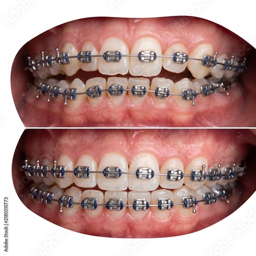 Clinical Dental Comparison of Teeth Straightening Progress During Braces Treatment