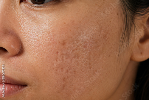 Macro close up of atrophic and pitted acne scars, enlarged pores, post acne marks and uneven skin texture on an Asian woman’s cheek
