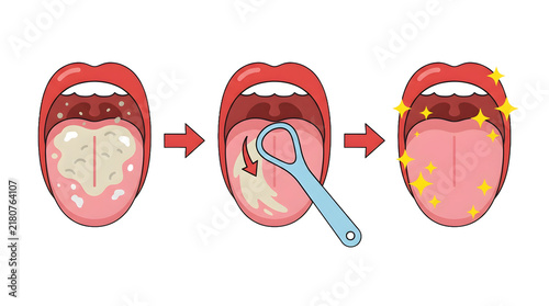 Tongue cleaning process with scraper vector illustration isolated on transparent background