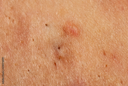 Obraz na plátně Pustule with acne blemishes