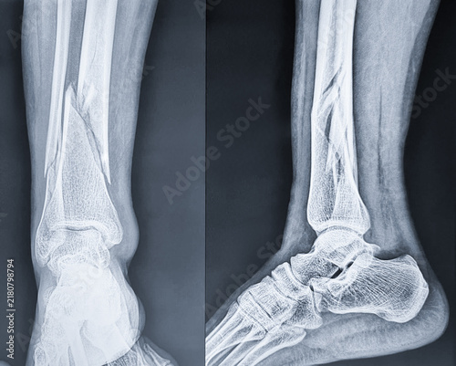 AP and lateral radiographs of the lower leg revealing a displaced oblique, spiral fracture of the distal third of the tibia and an associated fibular shaft fracture.