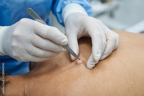 dermatologo ciste cisti operazione bisturi 