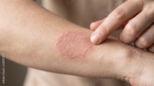 Close up shot showing a person pointing at a large red scaly patch of dry skin on their forearm indicating a potential dermatological health issue today