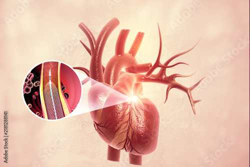 3D medical illustration demonstrating a coronary stent implant during a human heart angioplasty procedure to open arteries.