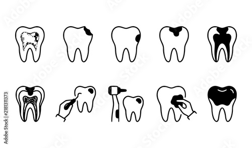 Dental Cavity Stages Tooth Repair and Filling Outline Vector Icon Collection