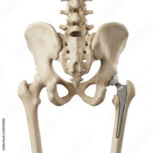 Medical Hip Replacement Prosthesis Anatomy Detailed Human Skeleton