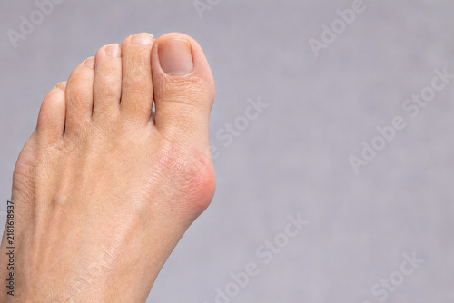 Hallux Valgus With Medial Bunion Deformity of the Big Toe